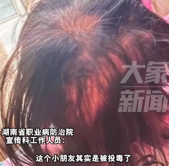 醫(yī)院回應3歲女孩鉈中毒：系人為投毒 日常能接觸到可能性小