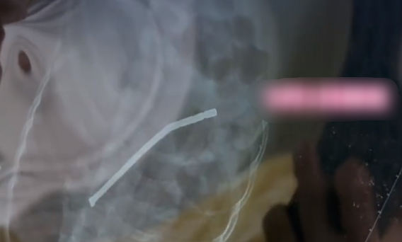 3歲娃吞下40多顆磁力珠致胃穿孔 奶奶以為能自行排出